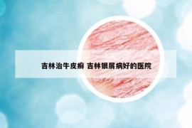 吉林治牛皮癣 吉林银屑病好的医院