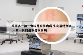 头屑多一扣一大块是银屑病吗 头皮屑特别多,一片一片的是不是银屑病