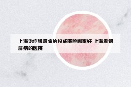 上海治疗银屑病的权威医院哪家好 上海看银屑病的医院