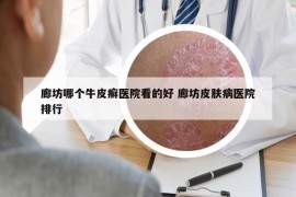 廊坊哪个牛皮癣医院看的好 廊坊皮肤病医院排行