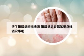 得了银屑病想喝啤酒 银屑病患者偶尔喝点啤酒没事吧