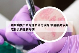 银屑病关节炎吃什么药比较好 银屑病关节炎吃什么药比较好使