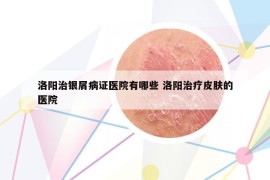 洛阳治银屑病证医院有哪些 洛阳治疗皮肤的医院