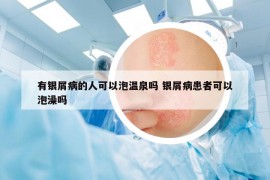 有银屑病的人可以泡温泉吗 银屑病患者可以泡澡吗