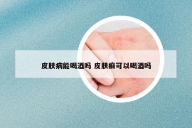 皮肤病能喝酒吗 皮肤癣可以喝酒吗