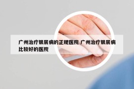 广州治疗银屑病的正规医院 广州治疗银屑病比较好的医院