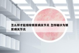怎么样才能排除银屑病关节炎 怎样确诊为银屑病关节炎