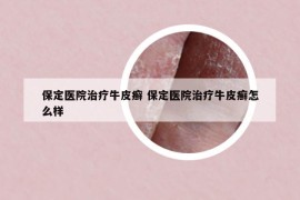 保定医院治疗牛皮癣 保定医院治疗牛皮癣怎么样