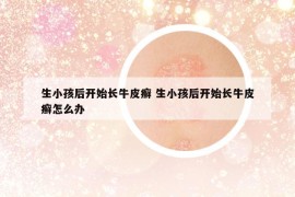 生小孩后开始长牛皮癣 生小孩后开始长牛皮癣怎么办