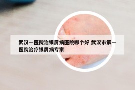 武汉一医院治银屑病医院哪个好 武汉市第一医院治疗银屑病专家