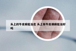 头上的牛皮癣能治愈 头上有牛皮病癣能治好吗