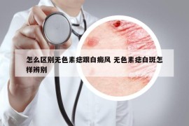 怎么区别无色素痣跟白癜风 无色素痣白斑怎样辨别