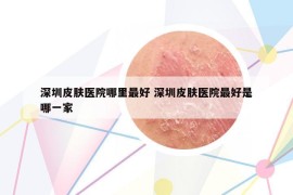 深圳皮肤医院哪里最好 深圳皮肤医院最好是哪一家