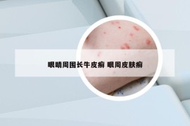 眼睛周围长牛皮癣 眼周皮肤癣