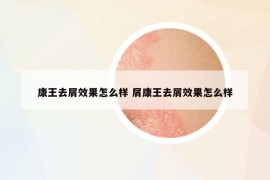 康王去屑效果怎么样 屑康王去屑效果怎么样