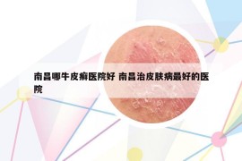 南昌哪牛皮癣医院好 南昌治皮肤病最好的医院