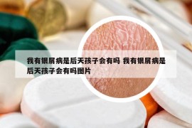 我有银屑病是后天孩子会有吗 我有银屑病是后天孩子会有吗图片