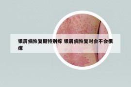 银屑病恢复期特别痒 银屑病恢复时会不会很痒