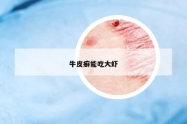 牛皮癣能吃大虾