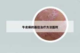 牛皮癣的最佳治疗方法医院