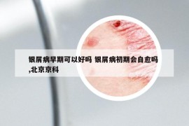 银屑病早期可以好吗 银屑病初期会自愈吗 ,北京京科