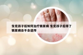 生完孩子后如何治疗银屑病 生完孩子后得了银屑病会不会遗传