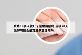 皮疹10多天就好了是银屑病吗 皮疹20天没好呢还会是艾滋病急性期吗