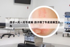 孩子一片一片牛皮癣 孩子得了牛皮皮癣怎么办