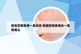 脓包型银屑病一直高烧 脓疱型银屑病会一直脓疱么
