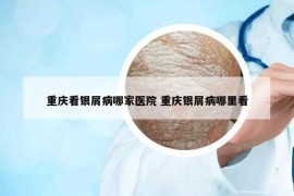 重庆看银屑病哪家医院 重庆银屑病哪里看