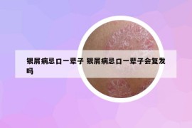 银屑病忌口一辈子 银屑病忌口一辈子会复发吗