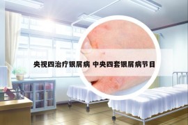 央视四治疗银屑病 中央四套银屑病节目