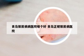青岛银屑病病医院哪个好 青岛正规银屑病医院