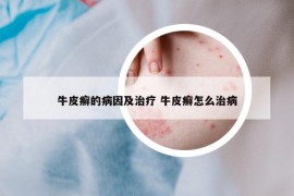 牛皮癣的病因及治疗 牛皮癣怎么治病