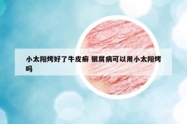小太阳烤好了牛皮癣 银屑病可以用小太阳烤吗