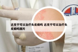 达克宁可以治疗头皮癣吗 达克宁可以治疗头皮癣吗图片