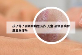 孩子得了副银屑病怎么办 儿童 副银屑病会反复发作吗