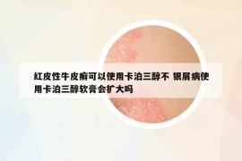 红皮性牛皮癣可以使用卡泊三醇不 银屑病使用卡泊三醇软膏会扩大吗