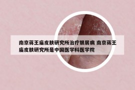 南京蒋王庙皮肤研究所治疗银屑病 南京蒋王庙皮肤研究所是中国医学科医学院