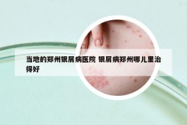 当地的郑州银屑病医院 银屑病郑州哪儿里治得好