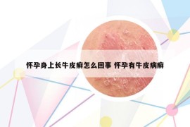怀孕身上长牛皮癣怎么回事 怀孕有牛皮病癣