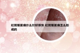 红斑银屑病什么针好得快 红斑银屑病怎么形成的