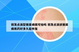 初发点滴型银屑病很可怕吗 初发点滴状银屑病用药好多久能恢复