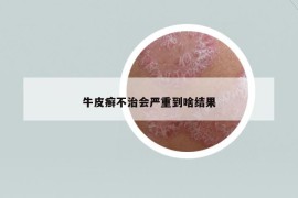 牛皮癣不治会严重到啥结果