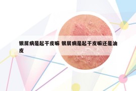 银屑病是起干皮嘛 银屑病是起干皮嘛还是油皮