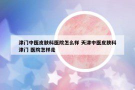津门中医皮肤科医院怎么样 天津中医皮肤科津门 医院怎样走