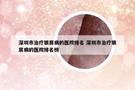 深圳市治疗银屑病的医院排名 深圳市治疗银屑病的医院排名榜