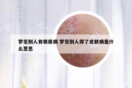梦见别人有银屑病 梦见别人得了皮肤病是什么意思
