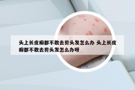 头上长皮癣都不敢去剪头发怎么办 头上长皮癣都不敢去剪头发怎么办呀