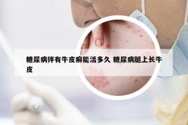 糖尿病伴有牛皮癣能活多久 糖尿病腿上长牛皮